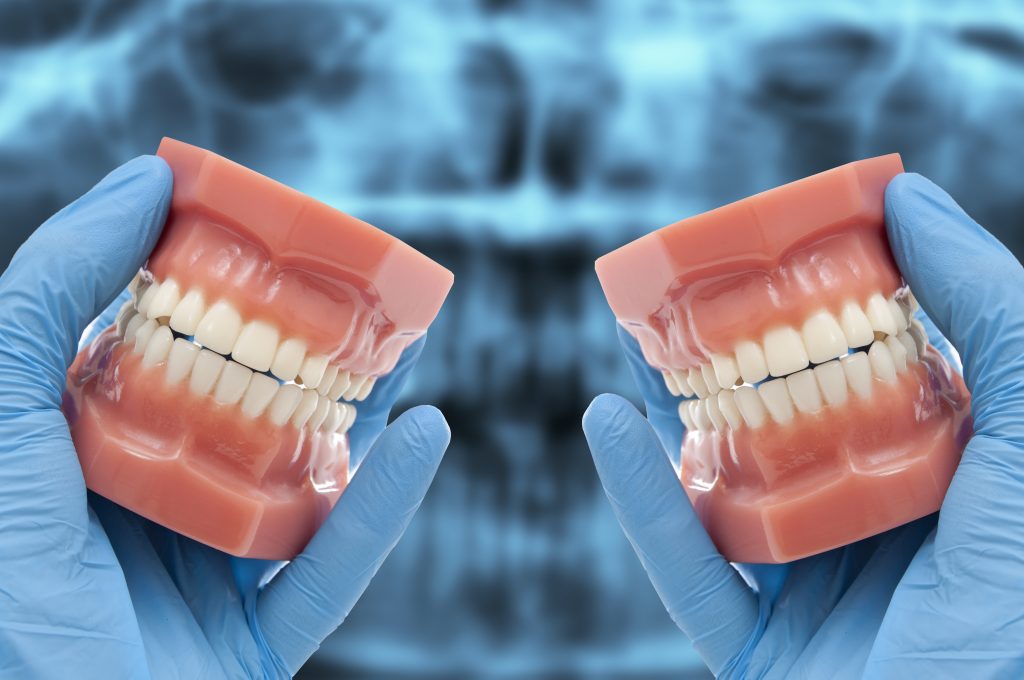 all-on-4 dental implant mold
