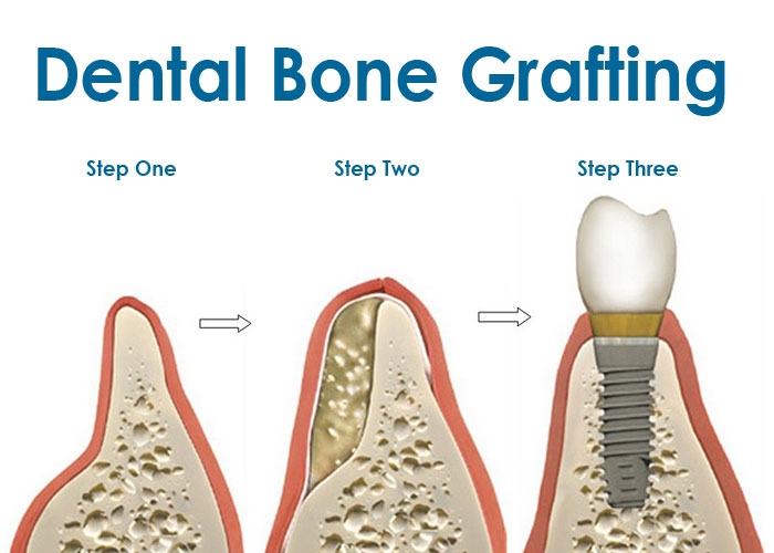 Dental Bone Graft at Facial & Oral Surgery Institute