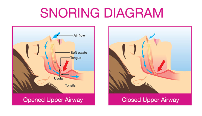 Snoring Diagram for Sleep Apnea