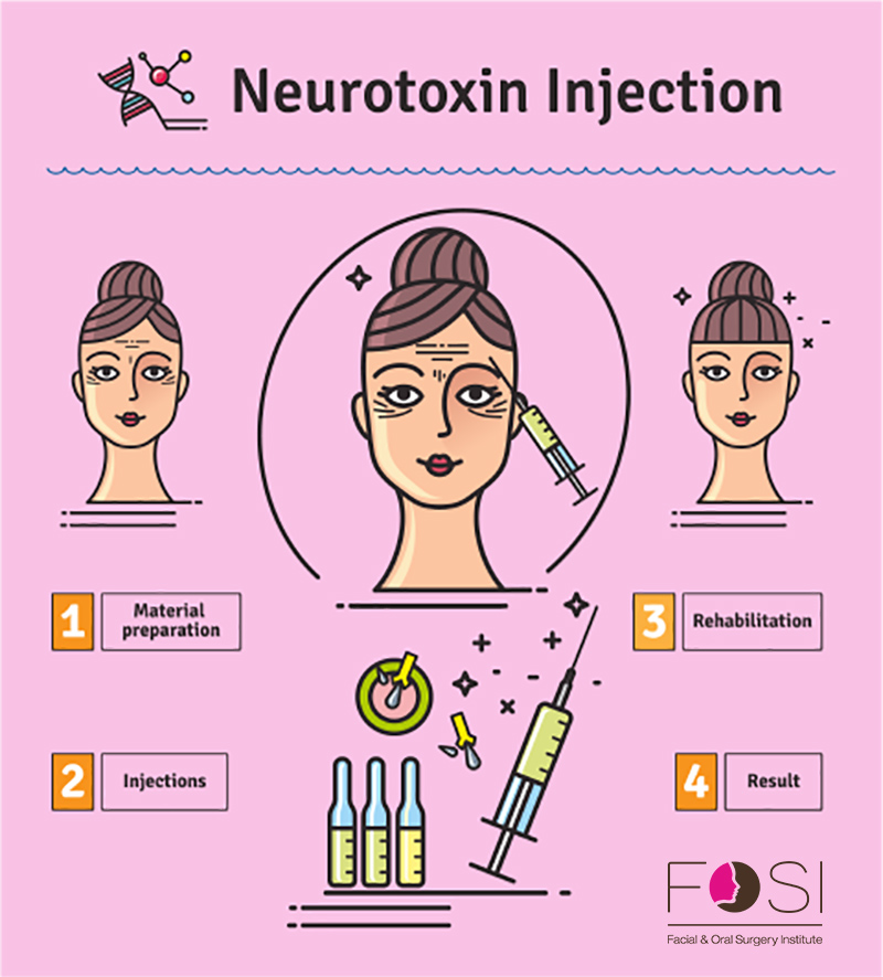Botox Injections Infographic by FOSI
