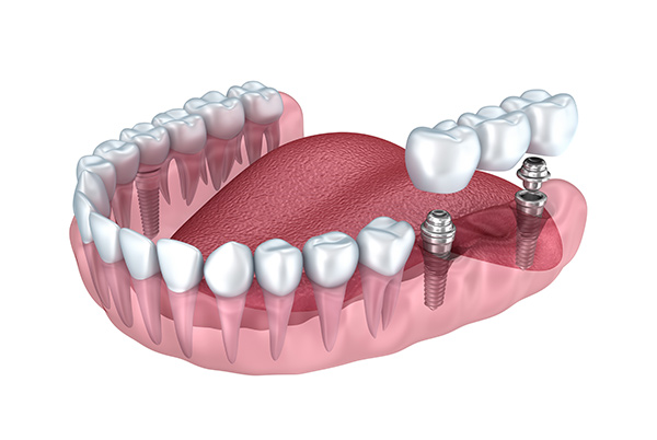 Dental implant bridge illustration