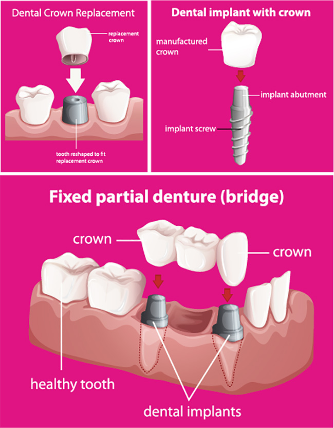 Dental Implant examples from Facial & Oral Surgery Institute