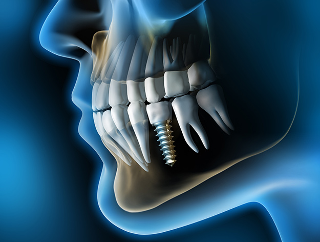 Dental implants facial view illustration