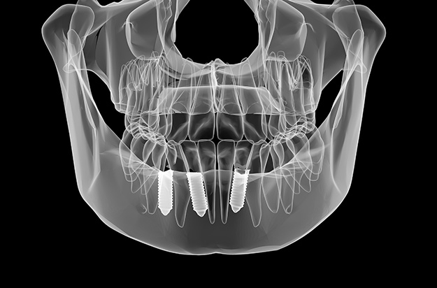 Dental implant xray