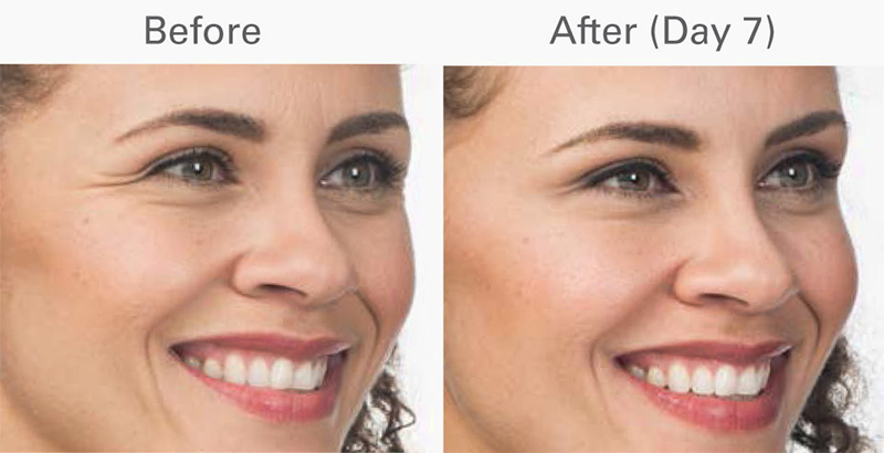 Before and After - Botox at Facial & Oral Surgery Institute