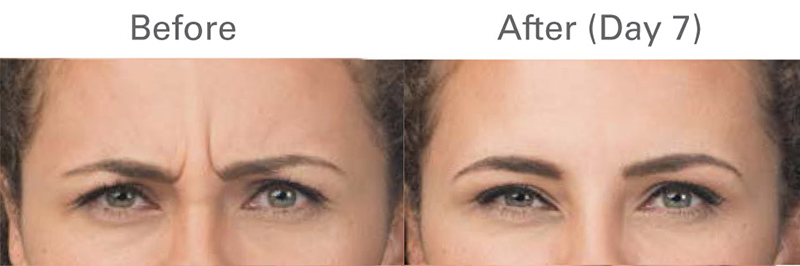 Before and After - Botox, Xeomin, and Dysport Injections