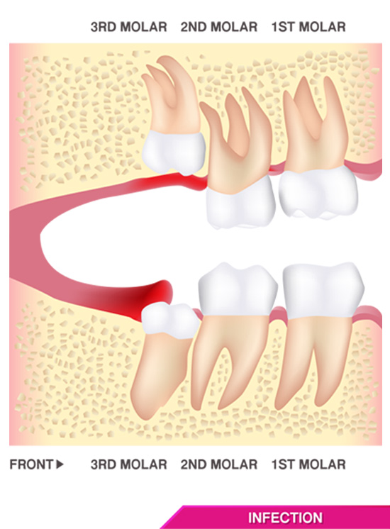 Wisdom teeth removal - Infection