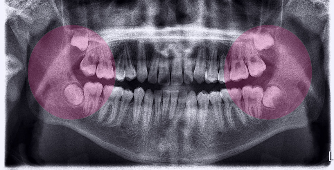 FOSI - Bryan - Wisdom Teeth Issues