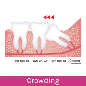 Wisdom Teeth Problems: Crowding