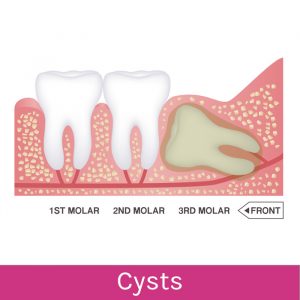 Wisdom Teeth Problems: Cysts