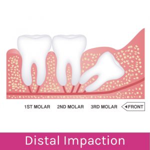 Wisdom Teeth Problems: Distal Impaction