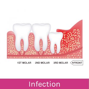 Wisdom Teeth Problems: Infection