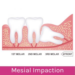Wisdom Teeth Problems: Mesial Impaction