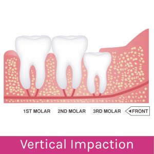 Wisdom Teeth Problems: Vertical Impaction