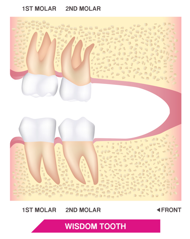 FOSI Wisdom Teeth - 1st molar, 2nd molar