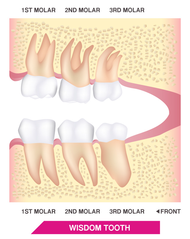 FOSI Wisdom Teeth - 1st molar, 2nd molar, 3rd molar