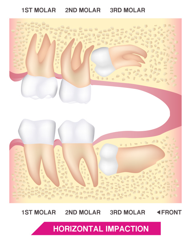 FOSI Wisdom Teeth - Horizontal Impaction