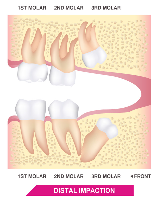 FOSI Wisdom Teeth - Distal Impaction