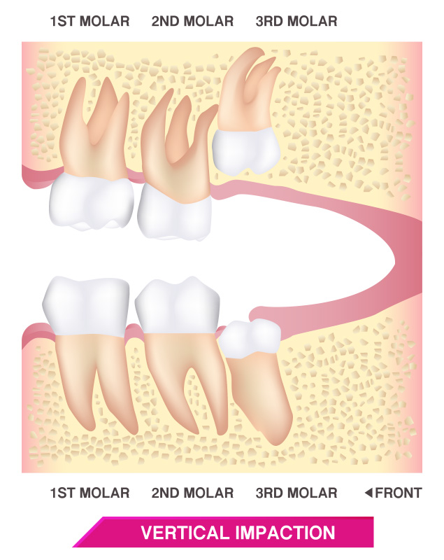 FOSI Wisdom Teeth - Vertical Impaction