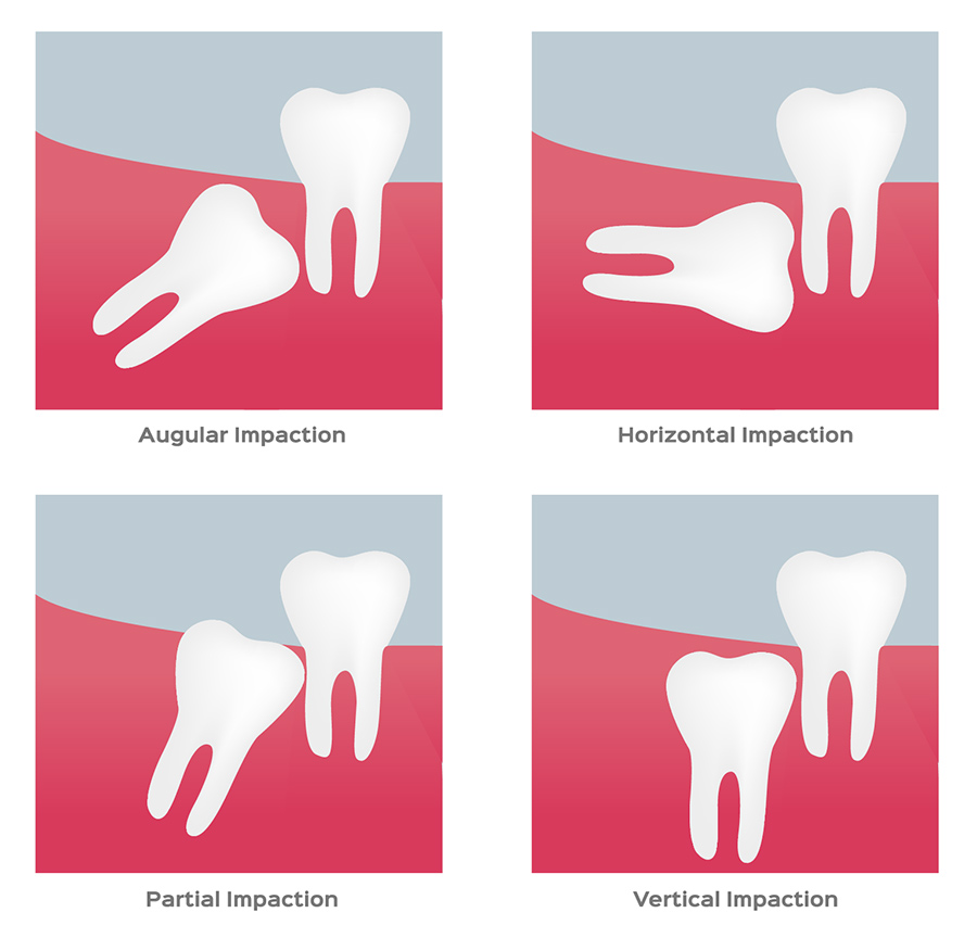 Illustration of impacted wisdom teeth