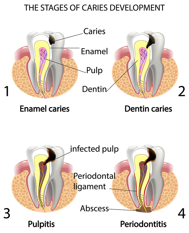 The Stages of Caries Development