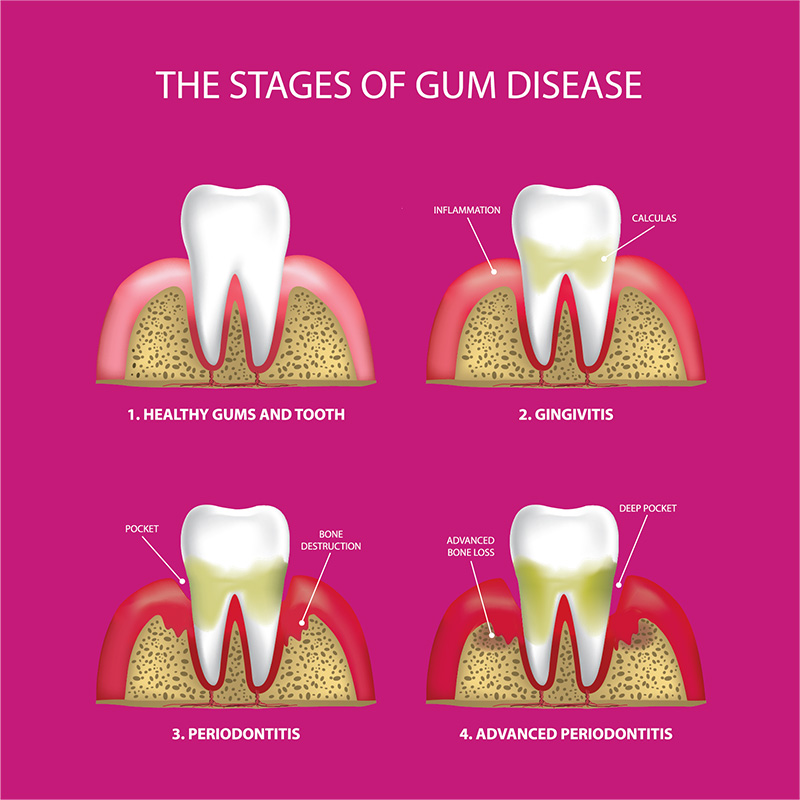 The Stages of Gum Disease by Dr. Navid Senehi, DDS., MD.