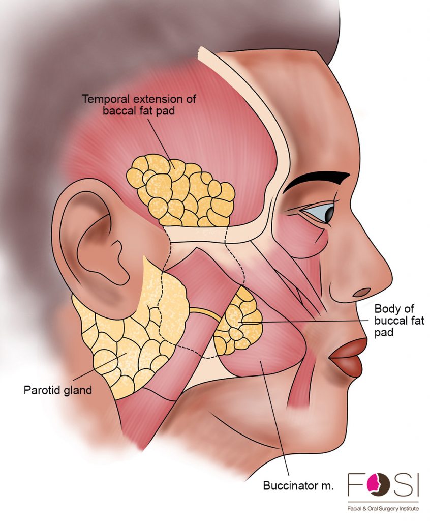 what-is-buccal-fat-removal-facial-oral-surgery-institute