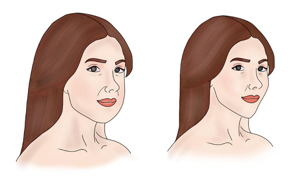 How To Get Rid of Face Fat